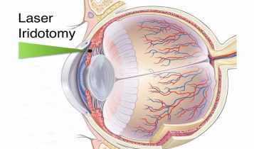 ইয়াগ পেরিফেরাল আইরিডোটমি Yag peripheral iridotomy laser treatment 4 ইয়াগ পেরিফেরাল আইরিডোটমি Yag peripheral iridotomy laser treatment 5